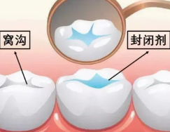 牙齿的金钟罩——窝沟封闭