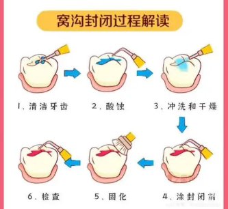 窝沟封闭四问四答