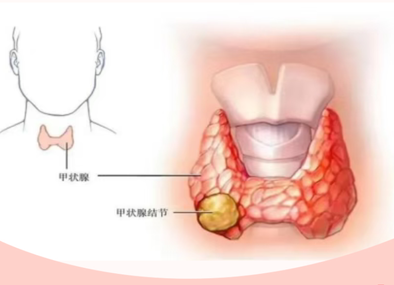 甲状腺超声检查科普小知识